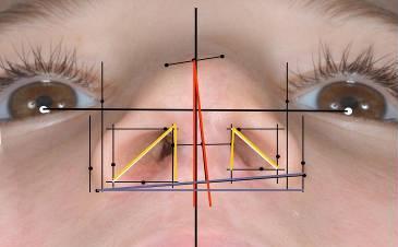 22. ábra Horizontális és vertikális antropometriai mérések az orr arcon belüli szimmetrikus elhelyezkedésének megítélésére.