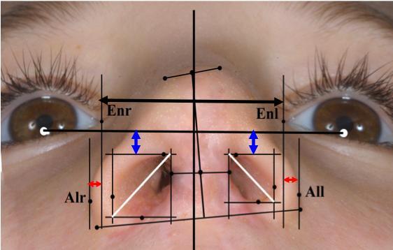 távolsága az endocanthion egyensektől, kék nyíl: az orrlyukak legfelső pontjának távolsága a bipupilláris vonaltól 23.