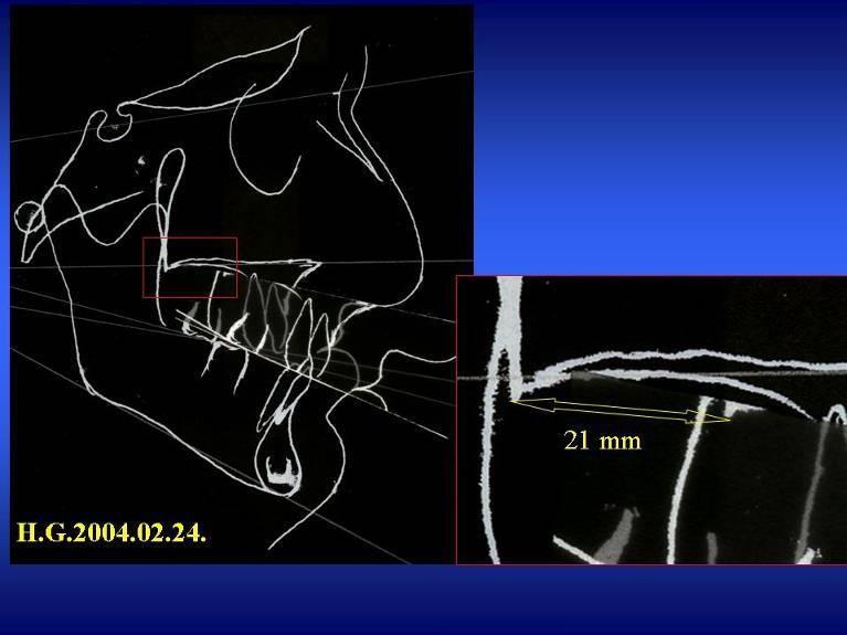 kezelési terv: sebészi- orthodontiai-