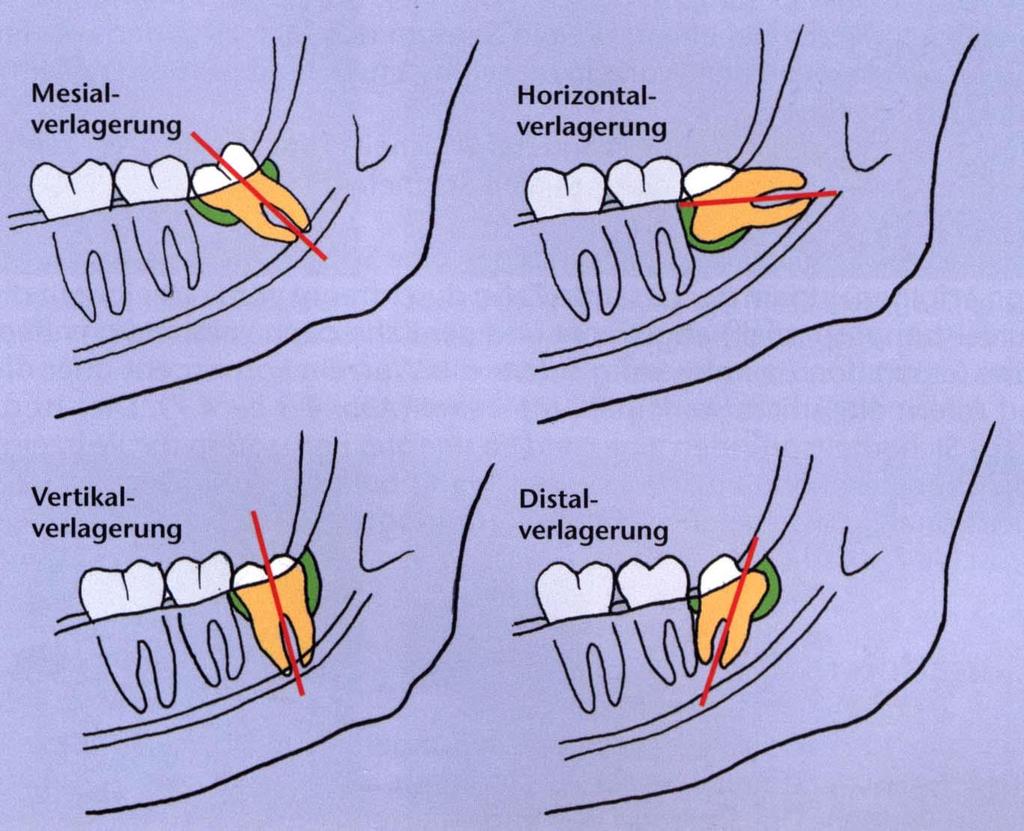 Az alsó bölcsességfogak leggyakoribb helyzeti