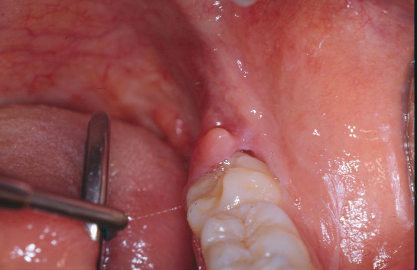 A pericoronitis a nehezített, elhúzódó fogáttörés, a dentitio difficilis tünetegyüttesének részeként