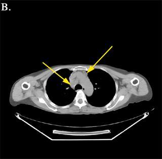 felhasználás receptorfunkciók PET/CT A PET