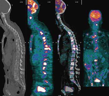 Sugárterápia CT PET PET/CT PET Sugárterápia: ionizáló sugárzás károsító