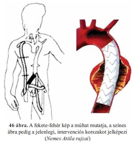 10 rupturált hasi aneurysmát operáltak meg és 50 stentgraft beültetésre került sor. 2013-tól vált alap szakképesítéssé az érsebészeti szakvizsga.