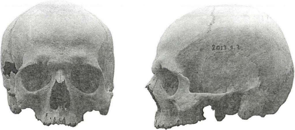 8. ábra. 50-60 éves férfi koponyája elöl- és oldalnézetben. Cromagnoid-A-x (ltsz.: 2013.9.7.; sírszám: Q23). Figure 8: A 50-60 year-old male, anterior and lateral view. Cromagnoid-A-x (inv. no.: 2013.9.7.; grave no.