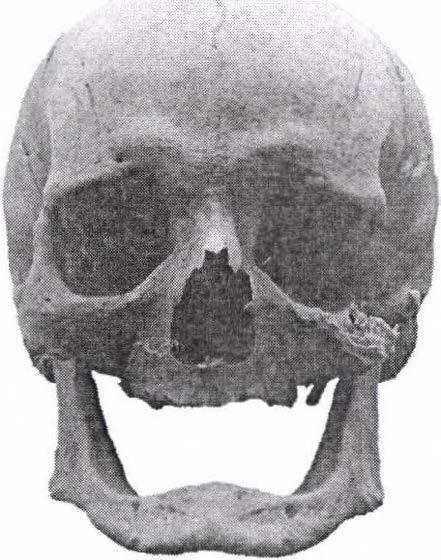 10. ábra: 45-55 éves férfi koponyája elöl- és oldalnézetben.