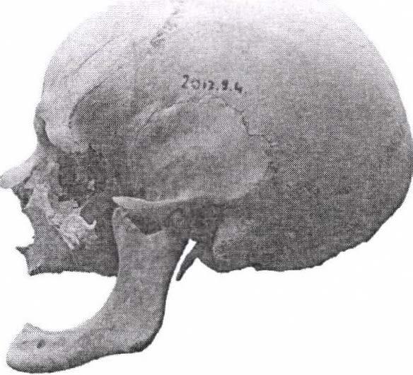 Figure 11: A 45-55 years old male, anterior and lateral view.