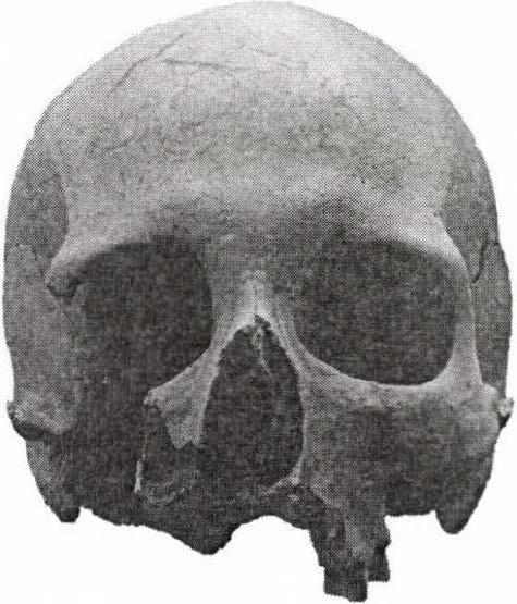 Figure 11: A 23-25 year-old male, anterior and lateral view.