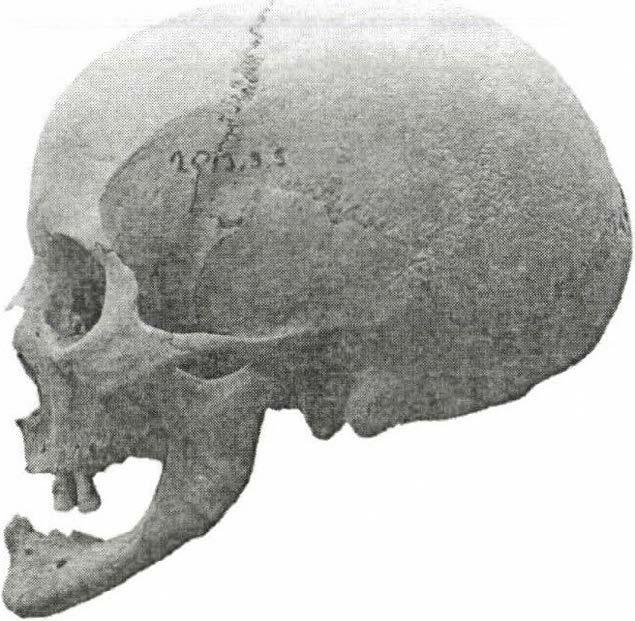 40-45 éves nő koponyája elöl- és oldalnézetben. Cromagnoid-A-x (ltsz.: 2013.9.6.; sírszám: Q20). Figure 14: A 40 55 year-old female, anterior and lateral view.
