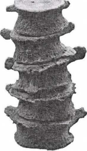 ábra: Spondylosis deformans egy 50-60 éves férfi ágyéki csigolyáin (ltsz.: 2008.