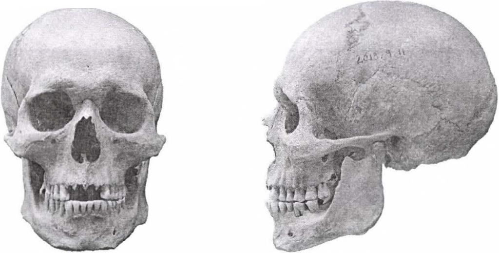 40-50 éves férfi koponyája elöl- és oldalnézetben. Cromagnoid-A (ltsz.: 2013.9.11.; sírszám: Q27).