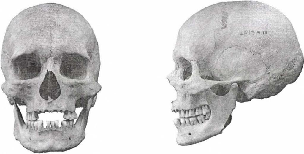 ; grave no.: Q27). 7. ábra. 35 40 éves férfi koponyája elöl- és oldalnézetben. Cromagnoid-A (ltsz.