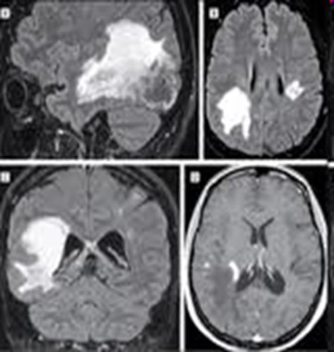 NMO-Spektrum betegség (Disease) (NMOSD) NMO-Spektrum betegségről (Disease) (NMOSD) akkor beszélünk, legalább egy NMO-ra jellemző tünet észlelhető 3 csigolyaszegmentum (vagy hosszabb kiterjedésű)