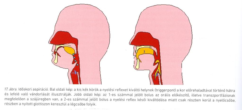 Presbyfágia Okok nyaki gerinc deformitások stroke fogak elvesztése ízérzés csökkenés nyálkahártya-szárazság izomtevékenység gyengülése bolusretenció a