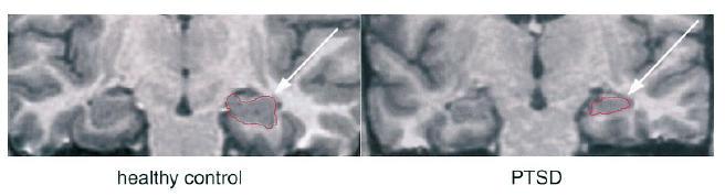 Volumetric difference between an MRI