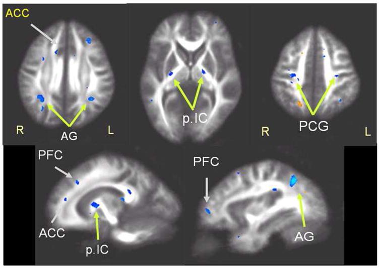 DTI in PTSD anterior cingulate cortex (ACC) prefrontal cortex (PFC) posterior central gyrus (PCG) angular gyrus (AG) posterior internal capsule (pic) Schuff, N