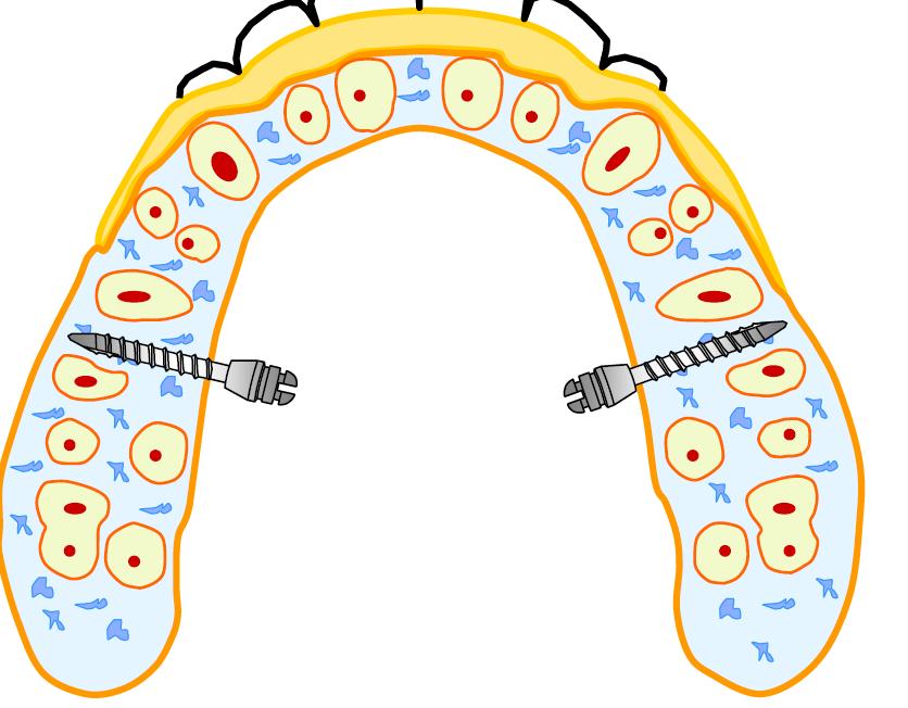 Corticalis és gingiva