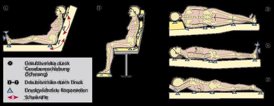 25 Decubitus nyíró erők miatt Decubitus nyomás