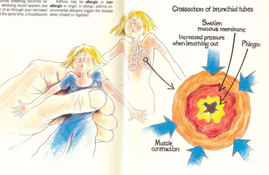 Allergiás asztma nehéz, sípoló légzés Bronchus