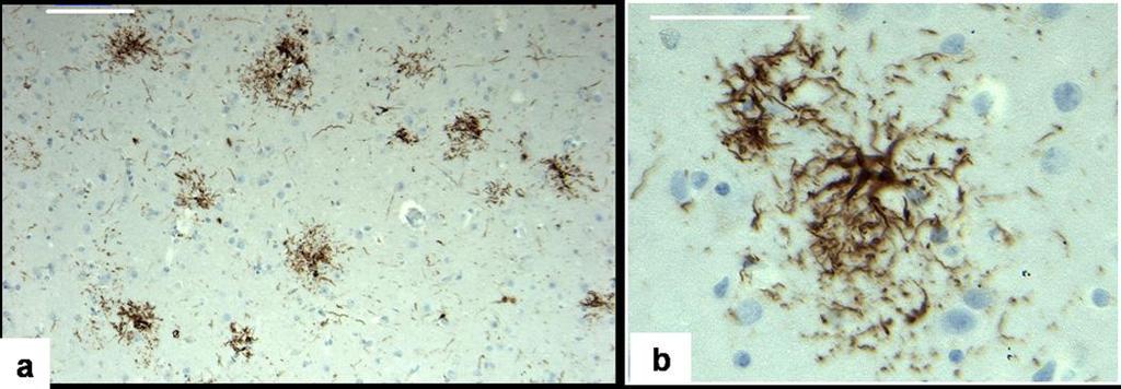 Neurofibrilláris gócok Tau proteinek mikrotubulus stabilizáció