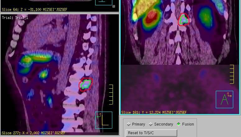 RT (66Gy) PSA emelkedik. 2016.05. PSA: 2,4ng/ml Kolin PET/CT : L1 proc.