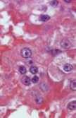 Sarcomatoid Rhabdoid Rhabdoid: G, nem külön