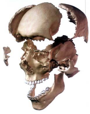 Skull & maxillo-facial fracture s Agy oedema Epidurális haematoma Subduralis vérzés és haematoma Traumás subarachnoidális vérzés