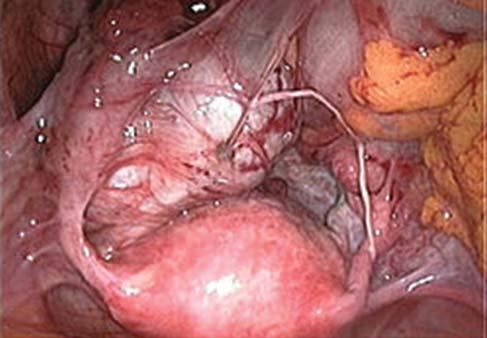 Fülöp Vilmos, Bokor Attila endometriumsejtek a szervezet bármely helyére (extragenitalis endometriosis).