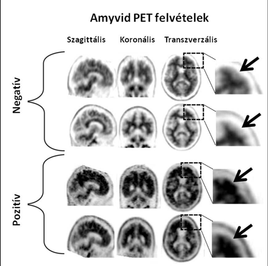1. ábra: Amyvid PET esetek, amelyek negatív eredményű (felső két sor) és pozitív eredményű (alsó két sor) felvételeket mutatnak.