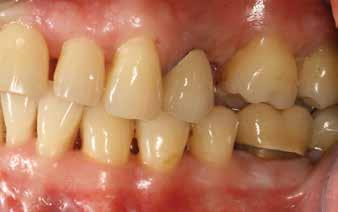 klinikai képek a) klinikai kép összezárt helyzetben d) alsó fogív bal