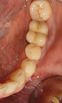 Badersten A, Nilveus R, Egelberg J: Effect of non-surgical periodontal