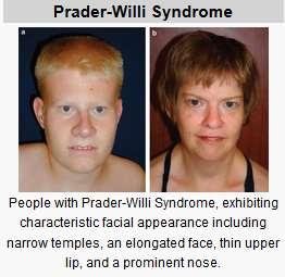 Prader-Willi syndrome is caused by the loss of genes in a specific region of chromosome 15. People normally inherit one copy of this chromosome from each parent.