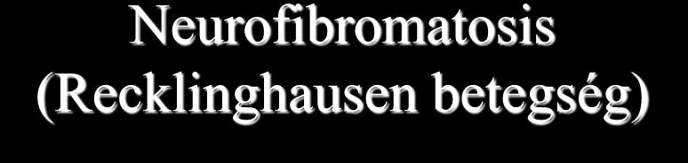 Neurofibromatosis (Recklinghausen betegség) Előfordulása 1:3000