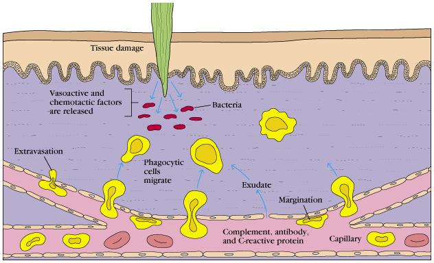 Akut gyulladás - Fertőzés vagy szövetkárosodás nem-specifikus reakciók kaszkádját indítja el - Azonnali válasz - szerepe, hogy megakadályozza a fertőzés és szövetkárosodás tovaterjedését Celsus: a