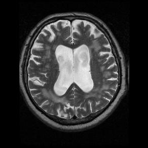 Az Ocularis Strke eseteiben MR jelek Small Vessels Disease (SVD) - lacunaris infarctus, Binswanger encephalpathia - SVD esetén jellegzetes MR tünetek: multiplex lacunaris infarctusk (<1,0 cm ) a mély