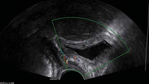 Praemenopausában, a menstruációs ciklus kezdetén, a menses ideje alatt normálisan 1 4 mm, a proliferációs szakban 5 7 mm, az ovuláció körüli idõszakban legfeljebb 11 mm vastag lehet a