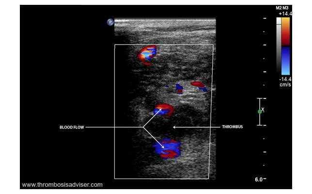 ultrahanggal Thrombus az érben A thrombus mögött: