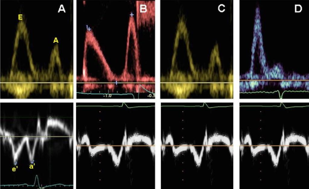 Diastolés dysfunkció stádiumai Norm.