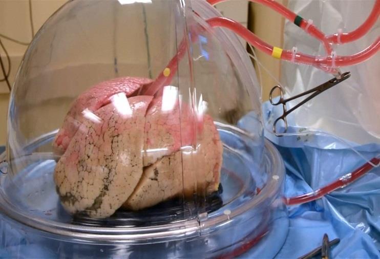 A gépi perfúzió típusai a. Normothermic regional perfusion: in situ perfusion of the thoracic and/or abdominal organs in the DCD donor before and at the time of organ retrieval; b.