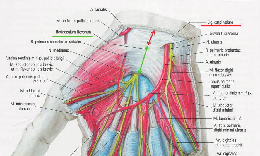 2. a ábra A három évvel korábbi műtétnél a ligamentum carpi volare behasítása történt (piros nyíllal jelölt terület), mert itt