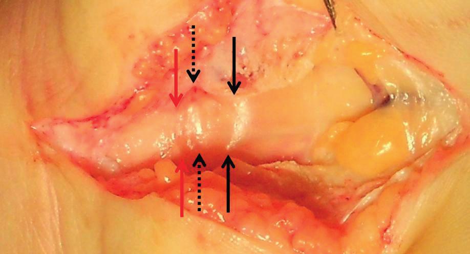 Carpal tunnel szindróma sikertelen kezelése minimal invazív eljárással 4. a ábra A retinaculum teljes átmetszése után vált láthatóvá az eredeti leszorítás helye (fekete nyíl).