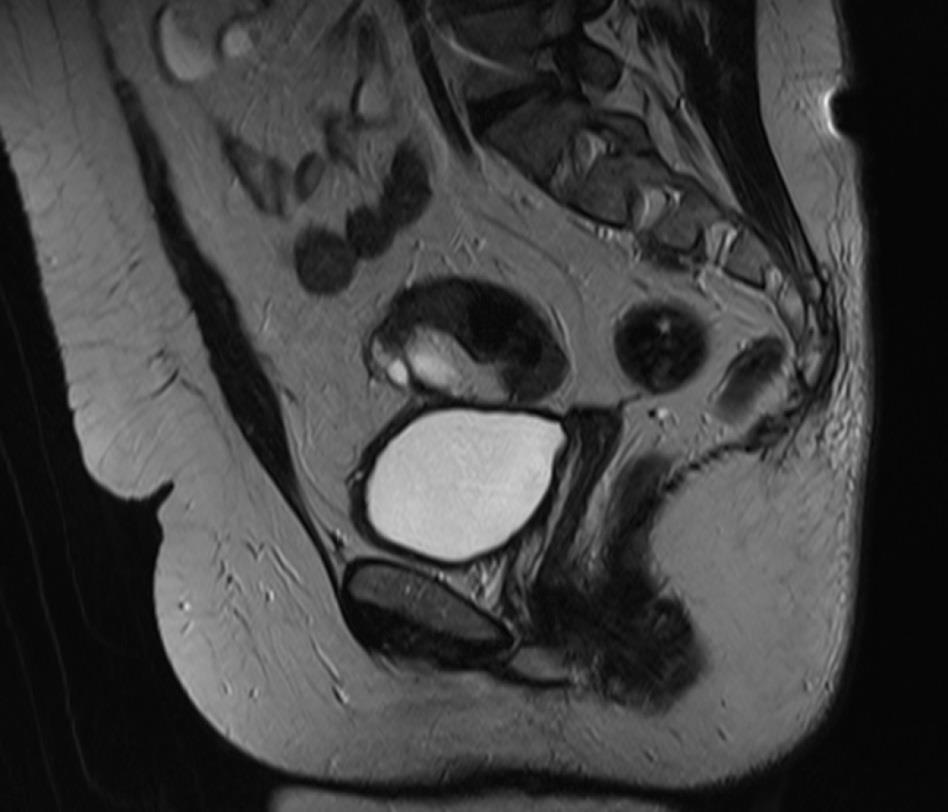 embolisatioja mellett a malignus tumor eredetű vérzések ellátása gyakran primeren szintén az intervenciós radiológia feladata.