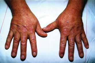 Megbeszélés Gyermekkorban az idiopathiás inflammatorikus myopathiák közül leggyakrabban a dermatomyositis fordul elő.