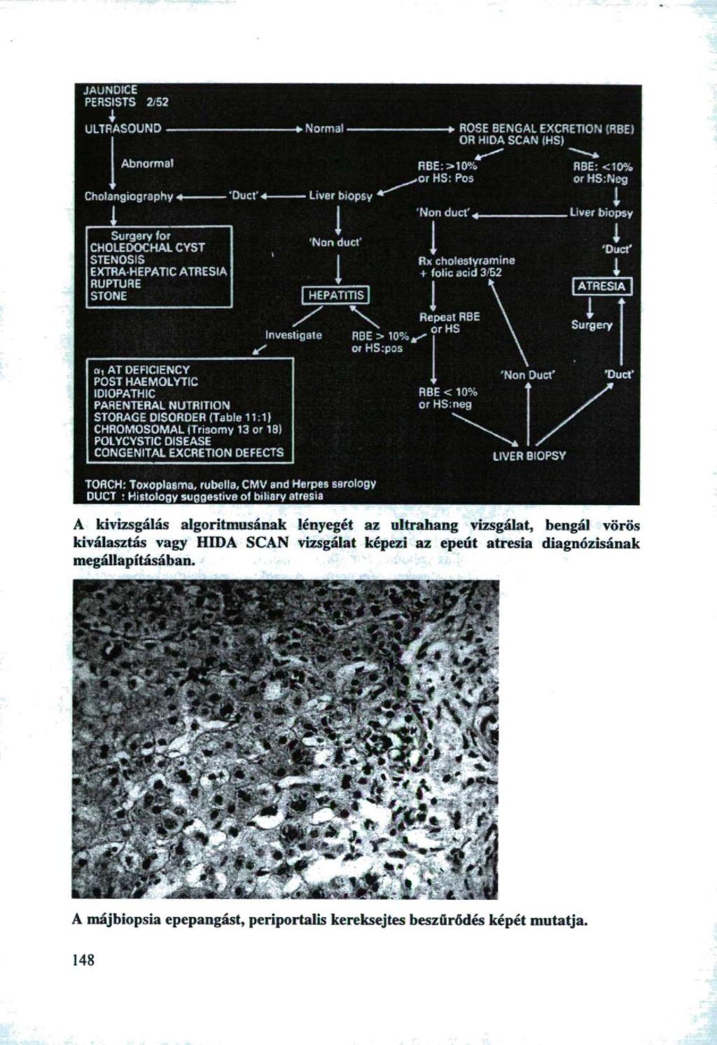 JAUNDICE PERSISTS 2/52 ULTRASOUND Normal ROSE BENGAL EXCRETION (R8E) OR H1DA SCAN IHS) Abnormal Liver biopsy Cholangiography Liver biopsy Surgery for CHOLEDOCHAL CYST STENOSIS EXTRA HEPATIC ATRESIA