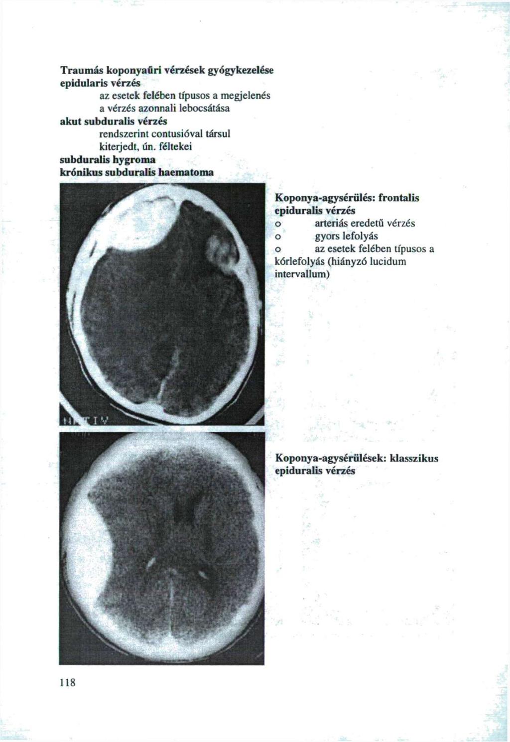 Traumás kpnyaűri vérzések gyógykezelése epidularis vérzés az esetek felében típuss a megjelenés a vérzés aznnali iebcsátása akut subduralis vérzés rendszerint cntusióval társul kiterjedt, ún.