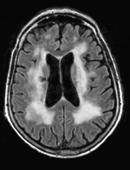 Binswanger-betegség (subcorticalis vascularis dementia) Hyperdenz
