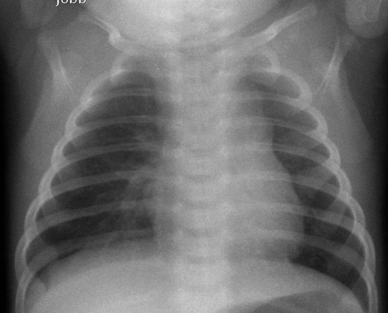 mellkasfelvételen a thymus