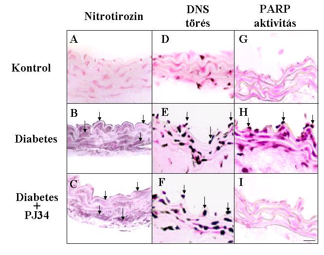11. ábra. Tirozin nitrálás, DNS törések és PARP aktiváció kontroll, diabéteszes és PJ34-gyel kezelt diabéteszes egerek aortafalában.