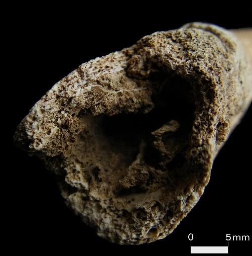 13: Sclerotic lesion in the spongy bone (right pubic bone).