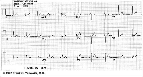 EKG alapjai Normál 12 elvezetéses EKG: EKG alapjai Az EKG papír: milliméterpapír Normál esetben a papír sebessége: 25mm/s (ettől eltérő is lehet, ha részletesebb időbeosztásra vagyunk kíváncsiak.